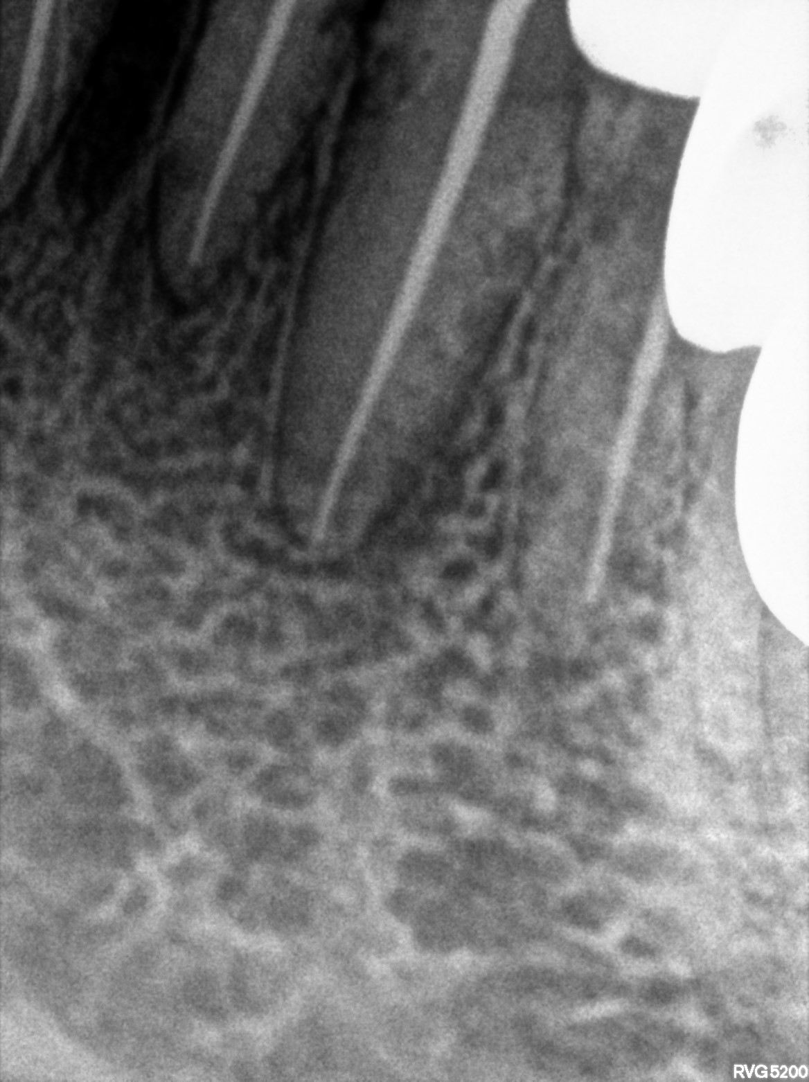 Dental X-ray